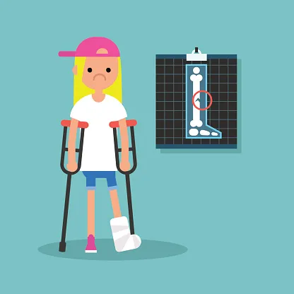 松葉杖をついた女の子とレントゲン写真のイラスト：下腿の疲労骨折を示している