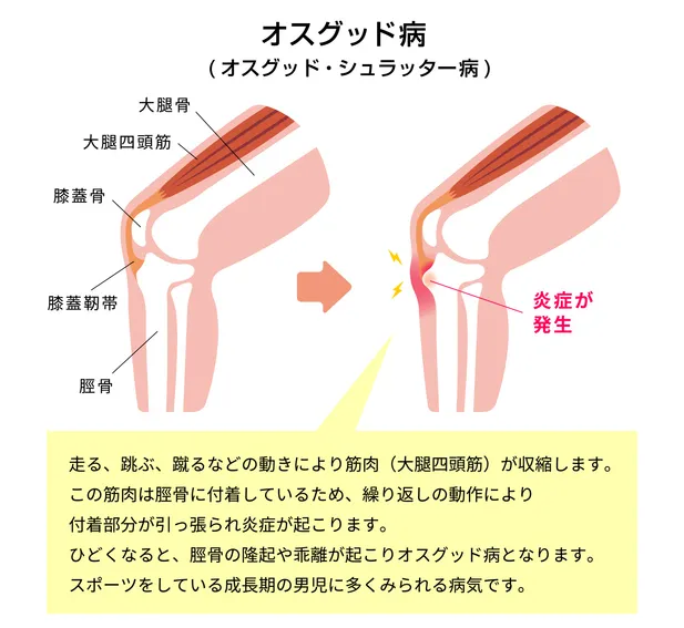 オスグット病の図解:大腿四頭筋が脛骨粗面を繰り返し引っ張ることで炎症が起こる様子