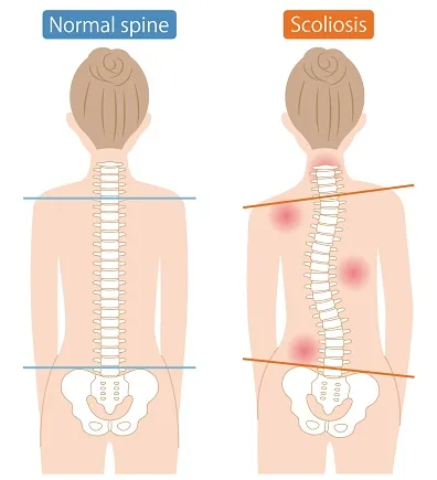 正常な背骨と側彎症の背骨の比較イラスト：正常な背骨はまっすぐで肩と骨盤が水平、側彎症の背骨はS字やC字に曲がり肩と骨盤が傾く